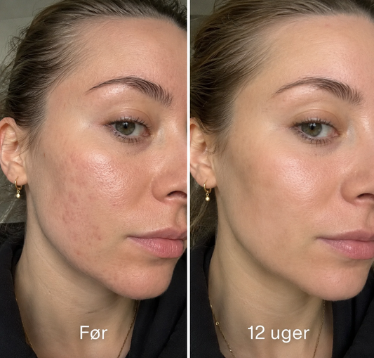 Oria Acne Scar Stick