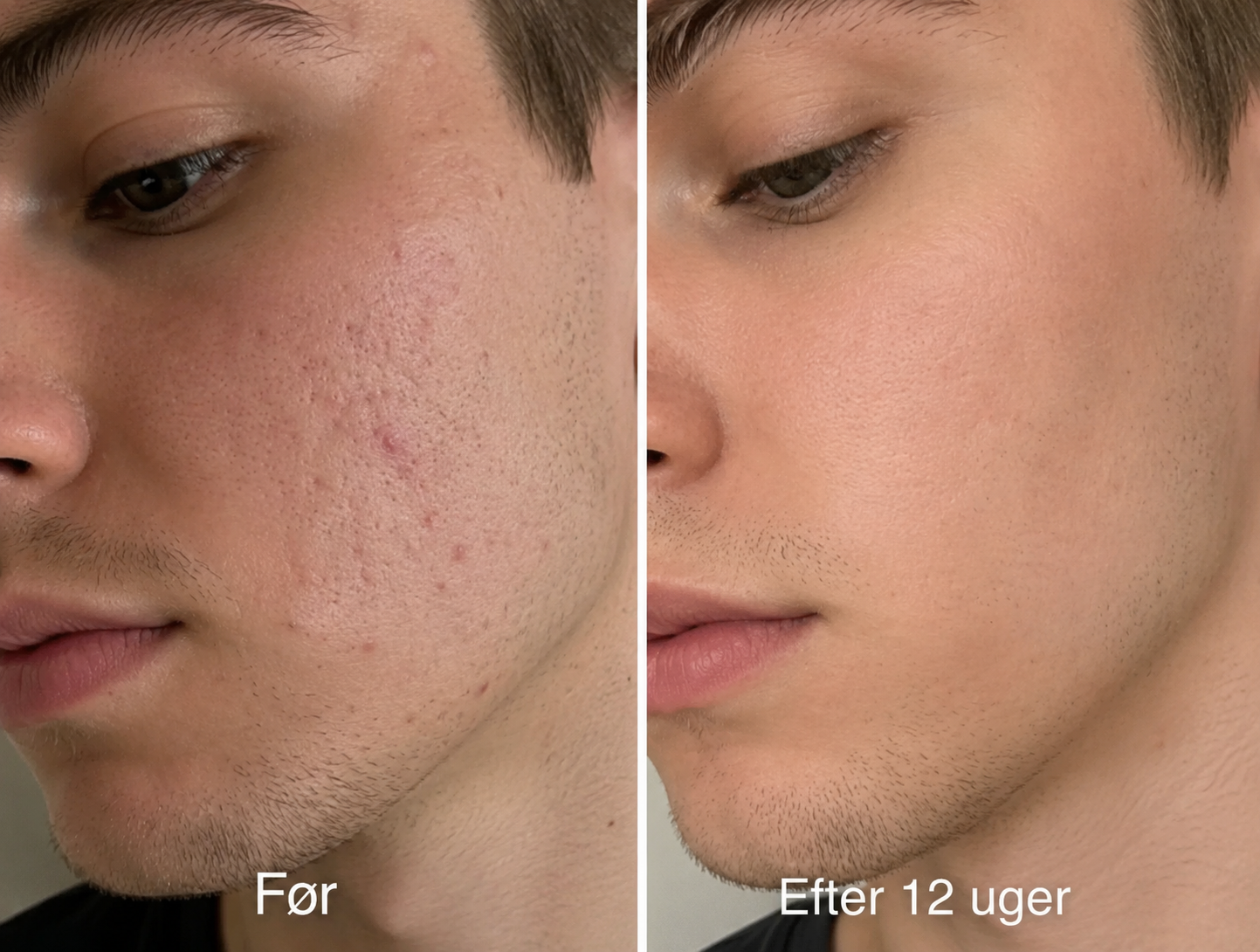 Oria Acne Scar Stick