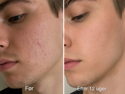 Oria Acne Scar Stick